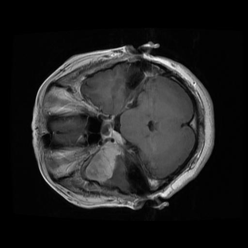 AiCNNs (Artificially-integrated Convolutional Neural Networks) for Brain Tumor Prediction