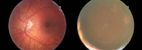 FuNet-40: fundus disease/abnormality classification using ensemble of fine-tuned pretrained convolution models