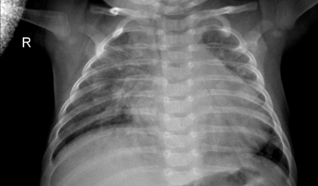Detecting pneumonia using convolutions and dynamic capsule routing for chest X-ray images